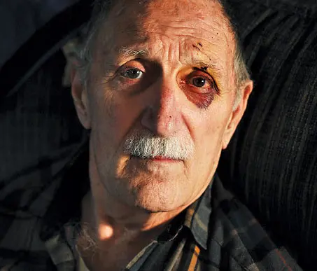 Norman Kenney with a black eye and bites and scratches on his face